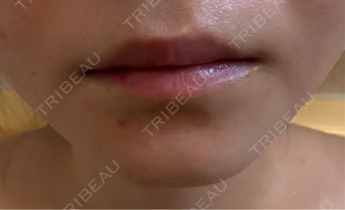 シワ取りボトックス / その他（輪郭） PRISM Beauty Clinic 町田院 AFTER メイン用