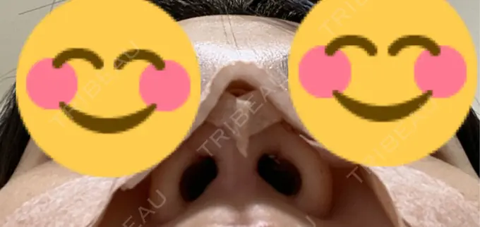 軟骨移植 / 鼻尖縮小 もとび美容外科クリニック 新宿院 DAY 2 メイン用