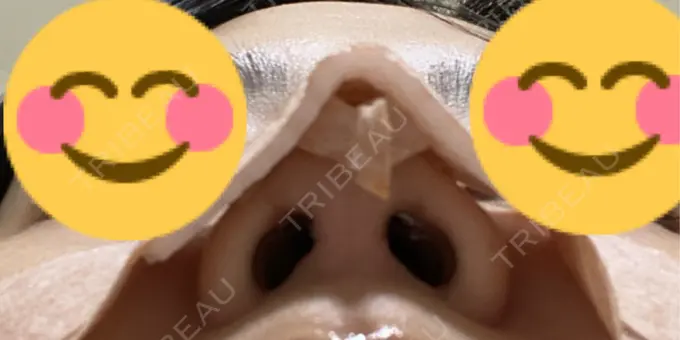 軟骨移植 / 鼻尖縮小 もとび美容外科クリニック 新宿院 DAY 3 メイン用