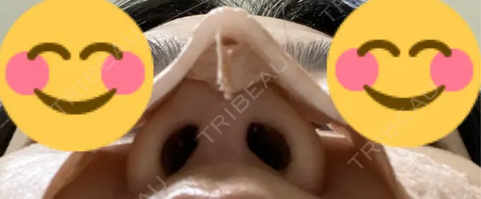 軟骨移植 / 鼻尖縮小 もとび美容外科クリニック 新宿院 DAY 5 メイン用