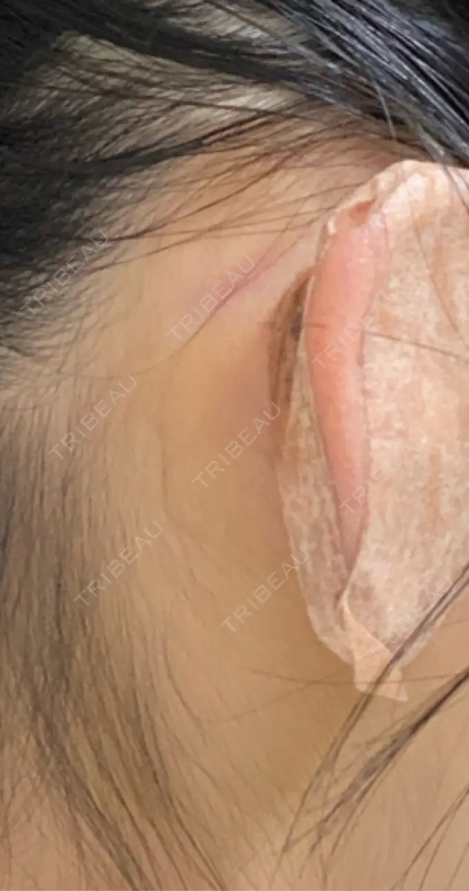 軟骨移植 / 鼻尖縮小 もとび美容外科クリニック 新宿院 DAY 5 メイン用