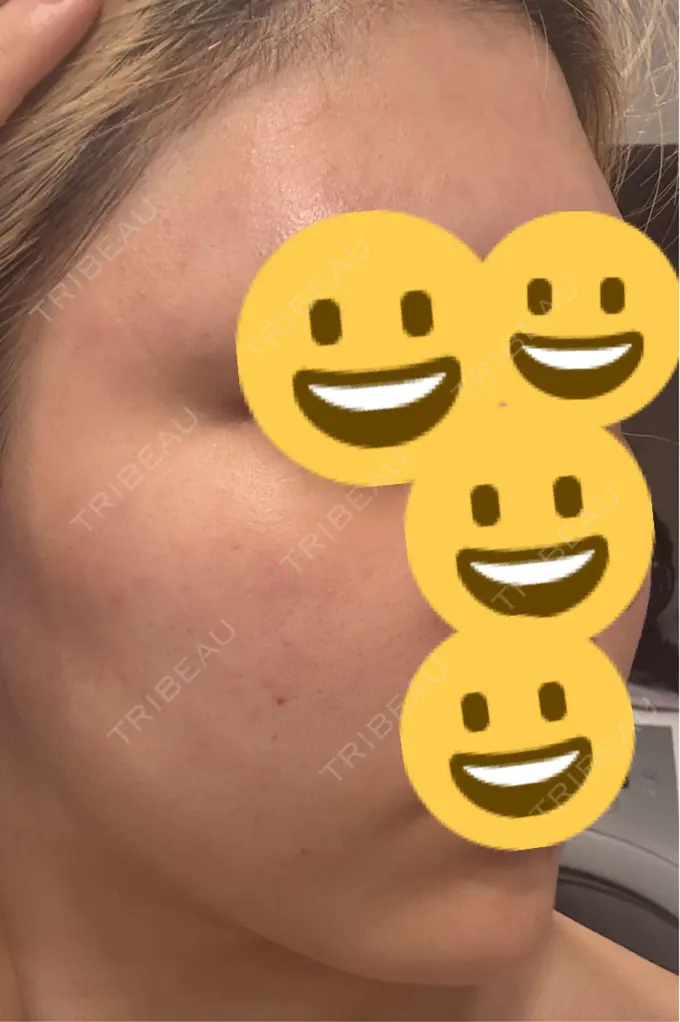 ボトックス（肩） / ピーリング（ニキビ・毛穴） / エレクトロポレーション / ルメッカ BITO BEAUTY CLINIC DAY 1 メイン用