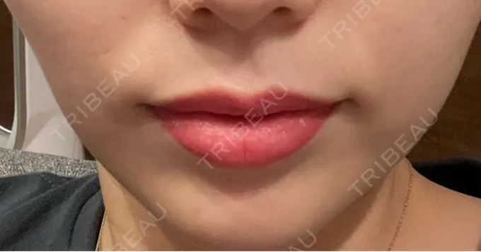 ボトックス（口角） ルラ美容クリニック 広島院 DAY 4 メイン用