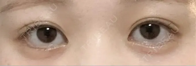 目尻切開 / タレ目形成・グラマラスライン（埋没） LOUIS CLINIC 二子玉川院【ルイクリニック】 DAY 1 メイン用