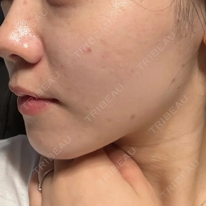 イオン導入 / 光治療（フォトフェイシャルなど） DAILY SKIN CLINIC 新宿院 DAY 1 メイン用