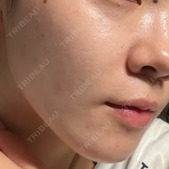 イオン導入 / 光治療（フォトフェイシャルなど） DAILY SKIN CLINIC 新宿院 DAY 1 メイン用