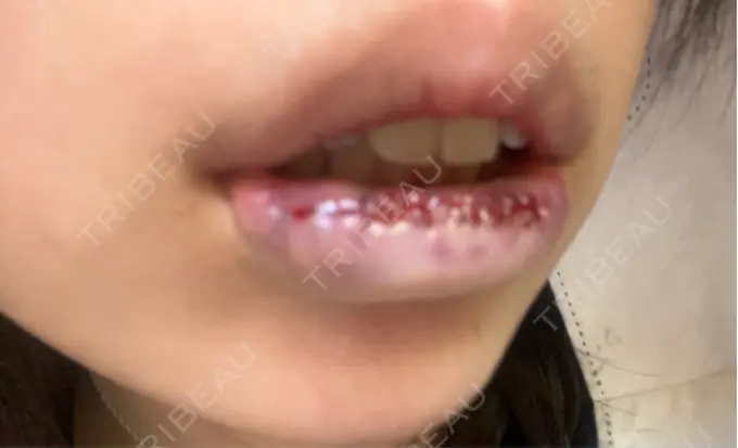 口唇縮小術 B-LINE CLINIC 池袋院 DAY 9 メイン用