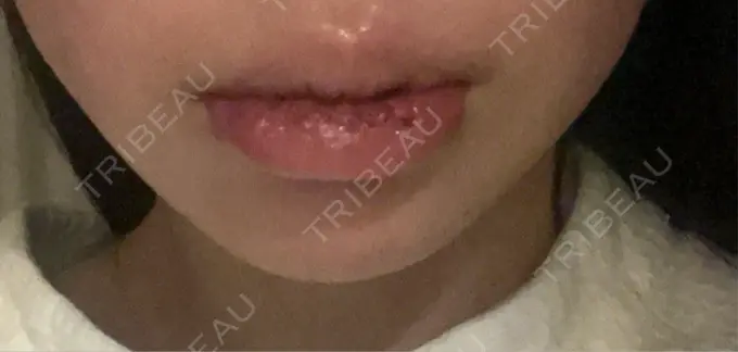 口唇縮小術 B-LINE CLINIC 池袋院 DAY 9 メイン用