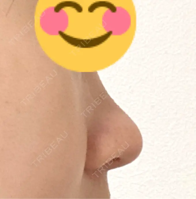 軟骨移植 / 鼻尖縮小 もとび美容外科クリニック 新宿院 AFTER メイン用