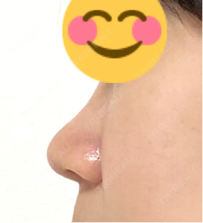 軟骨移植 / 鼻尖縮小 もとび美容外科クリニック 新宿院 DAY 6 メイン用