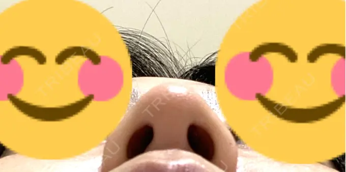 軟骨移植 / 鼻尖縮小 もとび美容外科クリニック 新宿院 DAY 6 メイン用