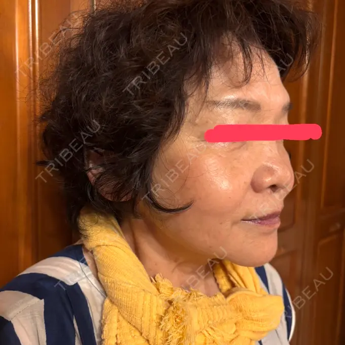 RF（高周波）たるみ治療 共立美容 池袋院 DAY 57 メイン用