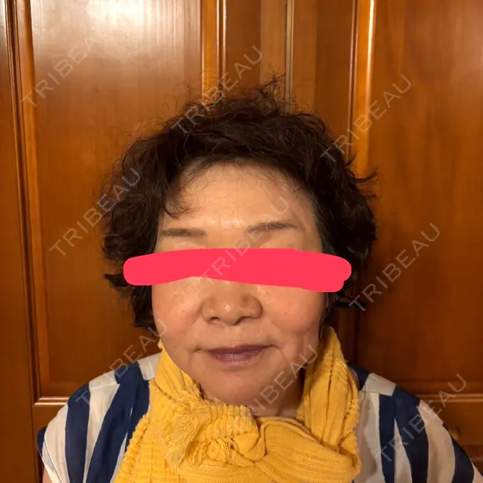 RF（高周波）たるみ治療 共立美容 池袋院 DAY 57 メイン用