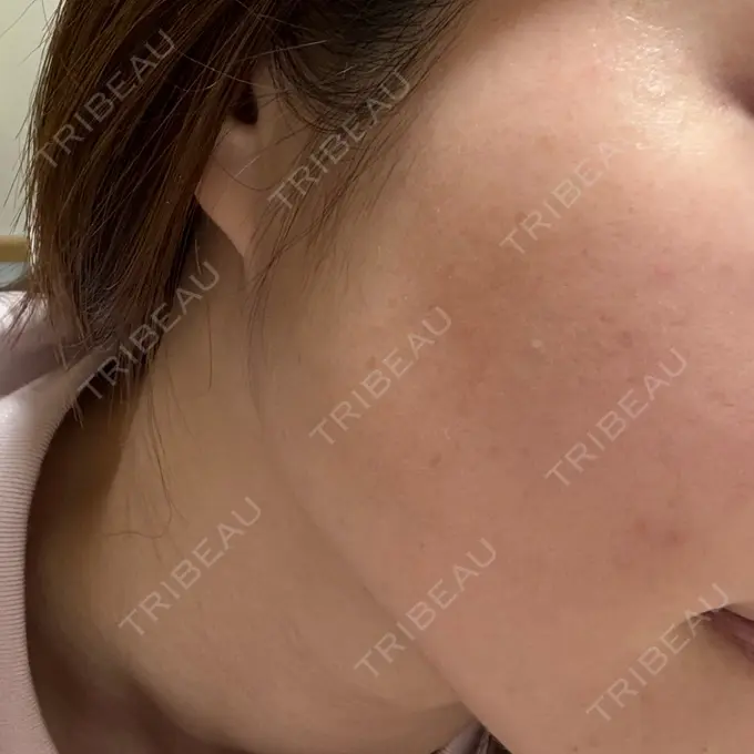 エレクトロポレーション / 光治療（フォトフェイシャルなど） / ピーリング（ハリ・ツヤ） ライズワン美容皮膚科クリニック DAY 4 メイン用