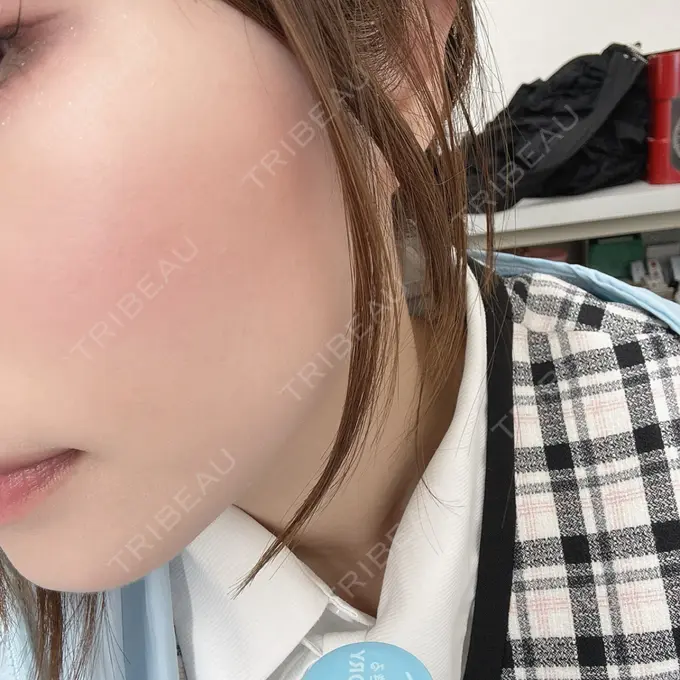 エレクトロポレーション / 光治療（フォトフェイシャルなど） / ピーリング（ハリ・ツヤ） ライズワン美容皮膚科クリニック DAY 4 メイン用