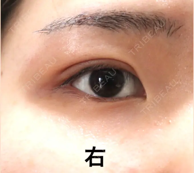 二重埋没 / 上まぶたの脂肪取り 東京ヒルズクリニック 岡崎院 DAY 23 メイン用