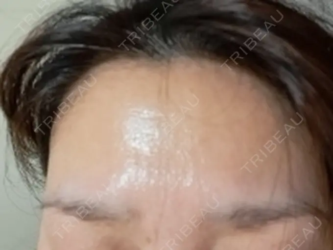 ピーリング（ニキビ・毛穴） / エレクトロポレーション / ピーリング（ハリ・ツヤ） SK新宿歌舞伎町美容外科・歯科 AFTER メイン用