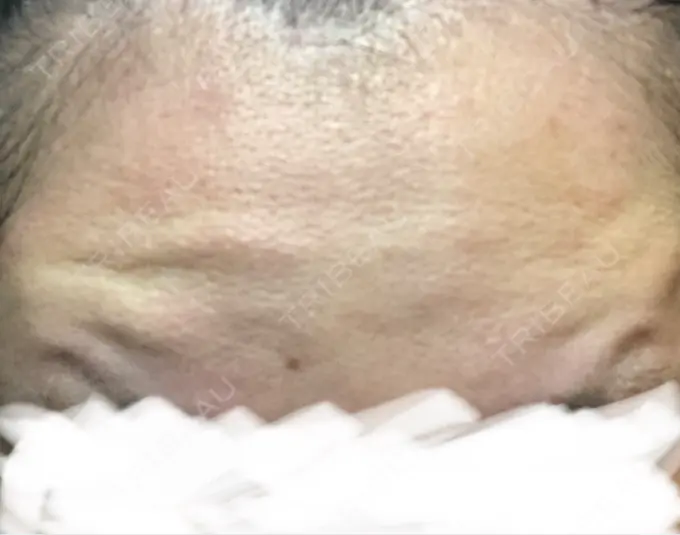 ボトックス（あご） / ボトックス（眉間） / ボトックス（目尻） / ボトックス（額） TCB東京中央美容外科 青森院 DAY 4 メイン用