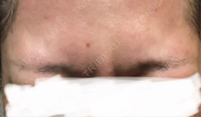 ボトックス（あご） / ボトックス（眉間） / ボトックス（目尻） / ボトックス（額） TCB東京中央美容外科 青森院 DAY 4 メイン用