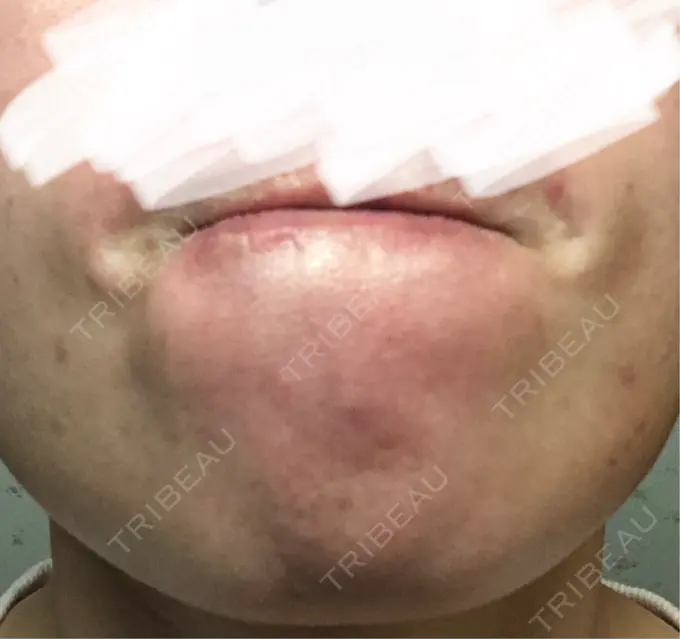 ボトックス（あご） / ボトックス（眉間） / ボトックス（目尻） / ボトックス（額） TCB東京中央美容外科 青森院 DAY 4 メイン用