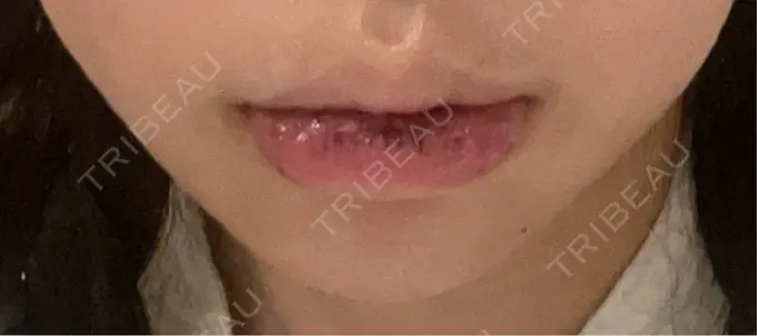 口唇縮小術 B-LINE CLINIC 池袋院 DAY 10 メイン用