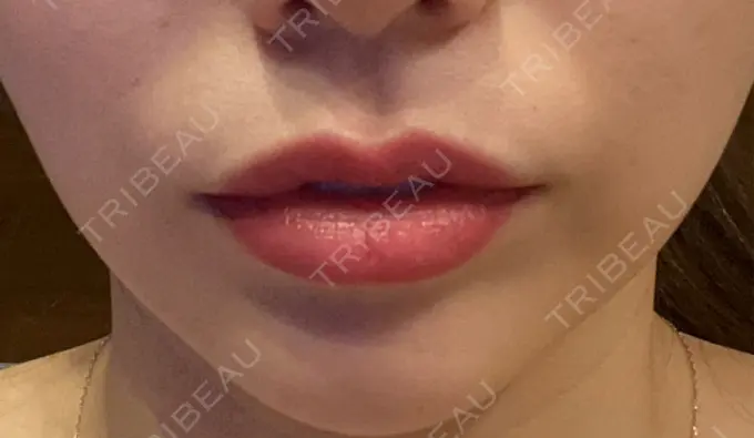 ボトックス（口角） ルラ美容クリニック 広島院 DAY 5 メイン用