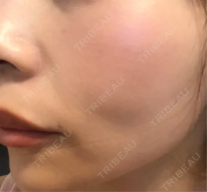 ピコレーザートーニング（美白・肝斑） / ピコフラクショナルレーザー（毛穴・ニキビ跡） APスキンクリニック銀座 DAY 8 メイン用