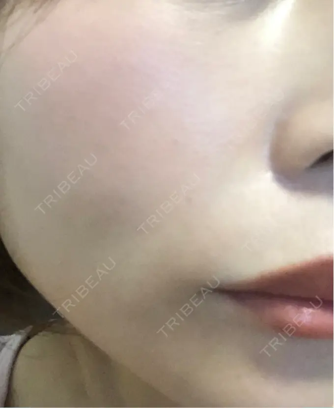 ピコレーザートーニング（美白・肝斑） / ピコフラクショナルレーザー（毛穴・ニキビ跡） APスキンクリニック銀座 DAY 8 メイン用