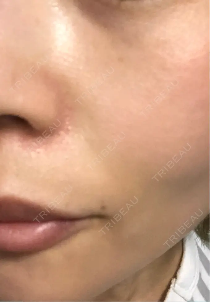 ピコレーザートーニング（美白・肝斑） / ピコフラクショナルレーザー（毛穴・ニキビ跡） APスキンクリニック銀座 DAY 6 メイン用