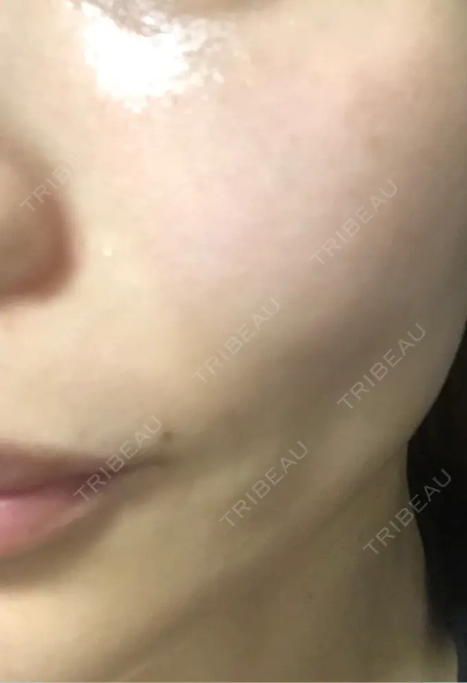 ピコレーザートーニング（美白・肝斑） / ピコフラクショナルレーザー（毛穴・ニキビ跡） APスキンクリニック銀座 DAY 7 メイン用