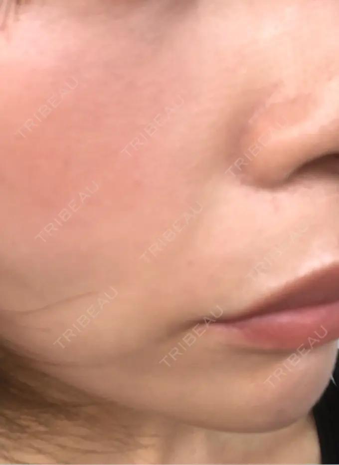 ピコレーザートーニング（美白・肝斑） / ピコフラクショナルレーザー（毛穴・ニキビ跡） APスキンクリニック銀座 DAY 7 メイン用