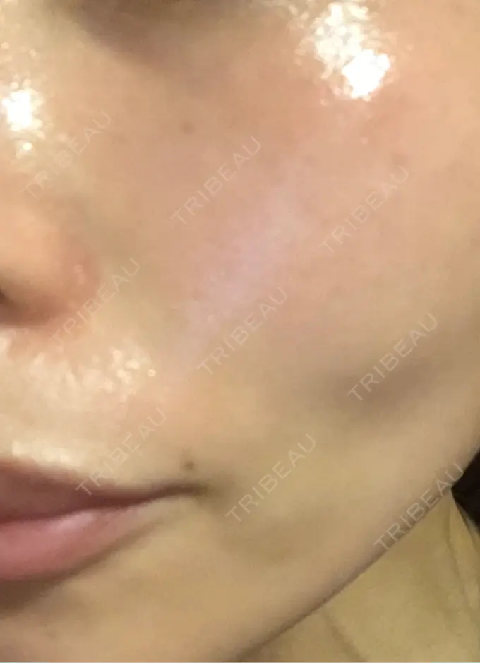 ピコレーザートーニング（美白・肝斑） / ピコフラクショナルレーザー（毛穴・ニキビ跡） APスキンクリニック銀座 DAY 9 メイン用