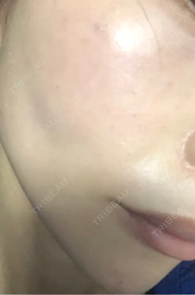 ピコレーザートーニング（美白・肝斑） / ピコフラクショナルレーザー（毛穴・ニキビ跡） APスキンクリニック銀座 DAY 9 メイン用