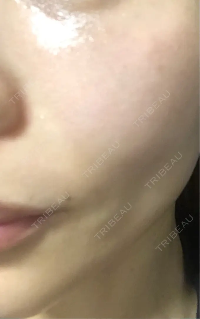 ピコレーザートーニング（美白・肝斑） / ピコフラクショナルレーザー（毛穴・ニキビ跡） APスキンクリニック銀座 AFTER メイン用