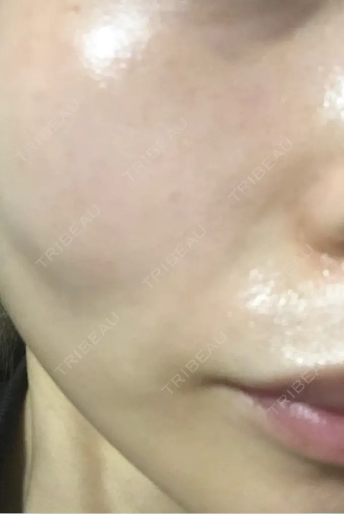 ピコレーザートーニング（美白・肝斑） / ピコフラクショナルレーザー（毛穴・ニキビ跡） APスキンクリニック銀座 DAY 11 メイン用