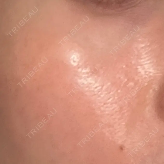 リジュラン 湘南美容クリニック 広島院 DAY 5 メイン用