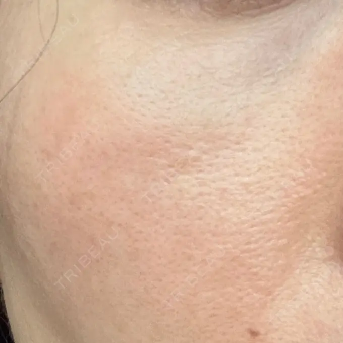 リジュラン 湘南美容クリニック 広島院 DAY 6 メイン用