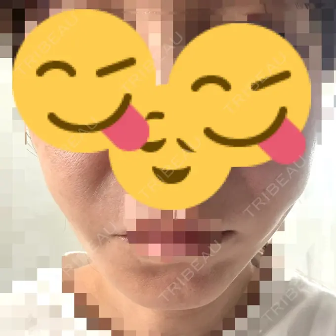 糸リフト アリエル美容クリニック 横浜院 DAY 6 メイン用