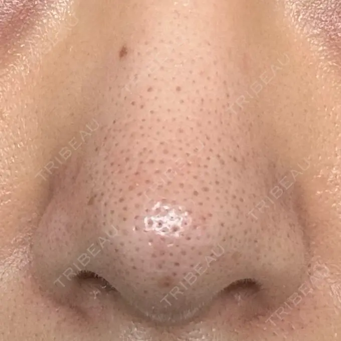 アグネス 日本美容・医療クリニック 六本木院 DAY 13 メイン用