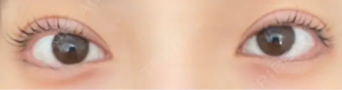 二重埋没 ROOTS Clinic DAY 4 メイン用