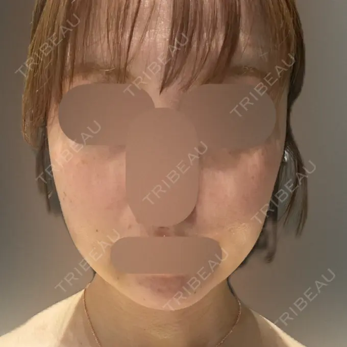 インディバ（顔） Casa de GRACIA GINZA 【カーサデグラシアギンザ】 DAY 4 メイン用