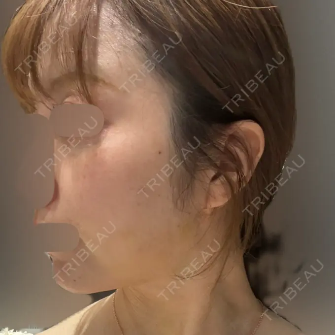 インディバ（顔） Casa de GRACIA GINZA 【カーサデグラシアギンザ】 DAY 4 メイン用