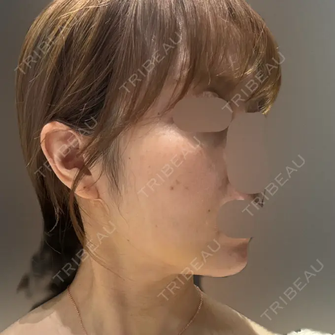 インディバ（顔） Casa de GRACIA GINZA 【カーサデグラシアギンザ】 DAY 4 メイン用