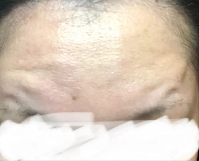 ボトックス（あご） / ボトックス（眉間） / ボトックス（目尻） / ボトックス（額） TCB東京中央美容外科 青森院 DAY 5 メイン用