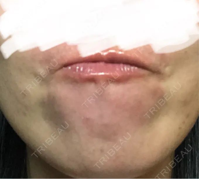 ボトックス（あご） / ボトックス（眉間） / ボトックス（目尻） / ボトックス（額） TCB東京中央美容外科 青森院 DAY 5 メイン用