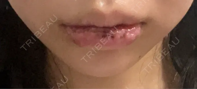 口唇縮小術 B-LINE CLINIC 池袋院 DAY 11 メイン用