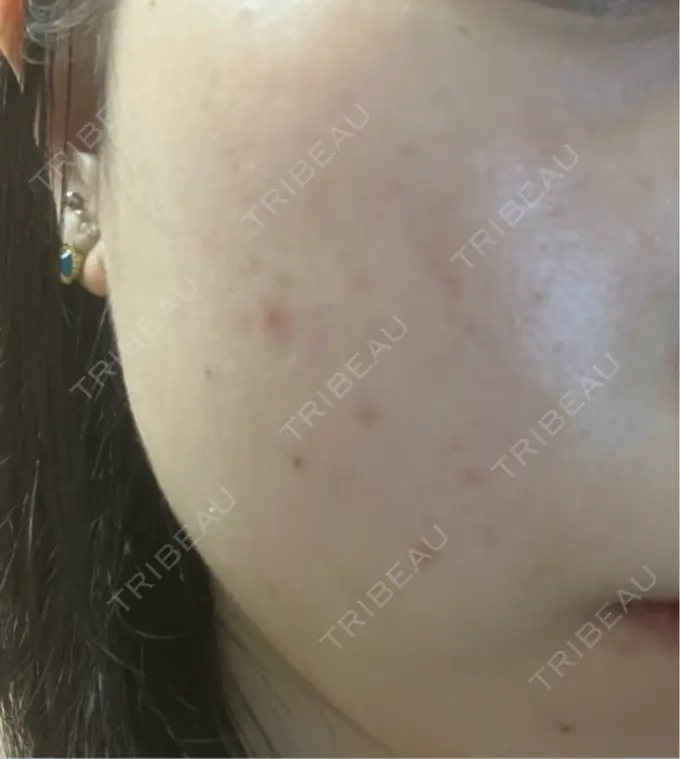 ルビーレーザー Designo Clinic （デジーノクリニック） AFTER メイン用