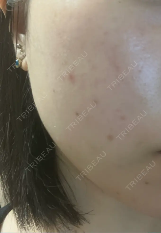 ルビーレーザー Designo Clinic （デジーノクリニック） DAY 9 メイン用