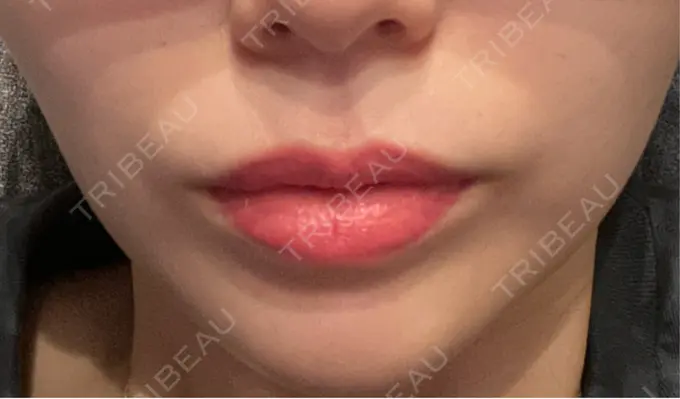 ボトックス（口角） ルラ美容クリニック 広島院 DAY 7 メイン用