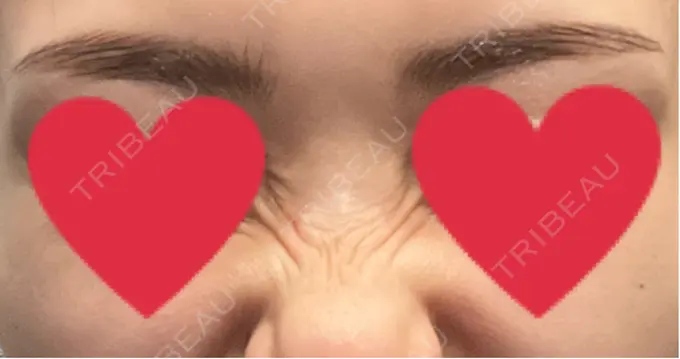 ボトックス（バニーライン） 共立美容外科 広島院 DAY 4 メイン用